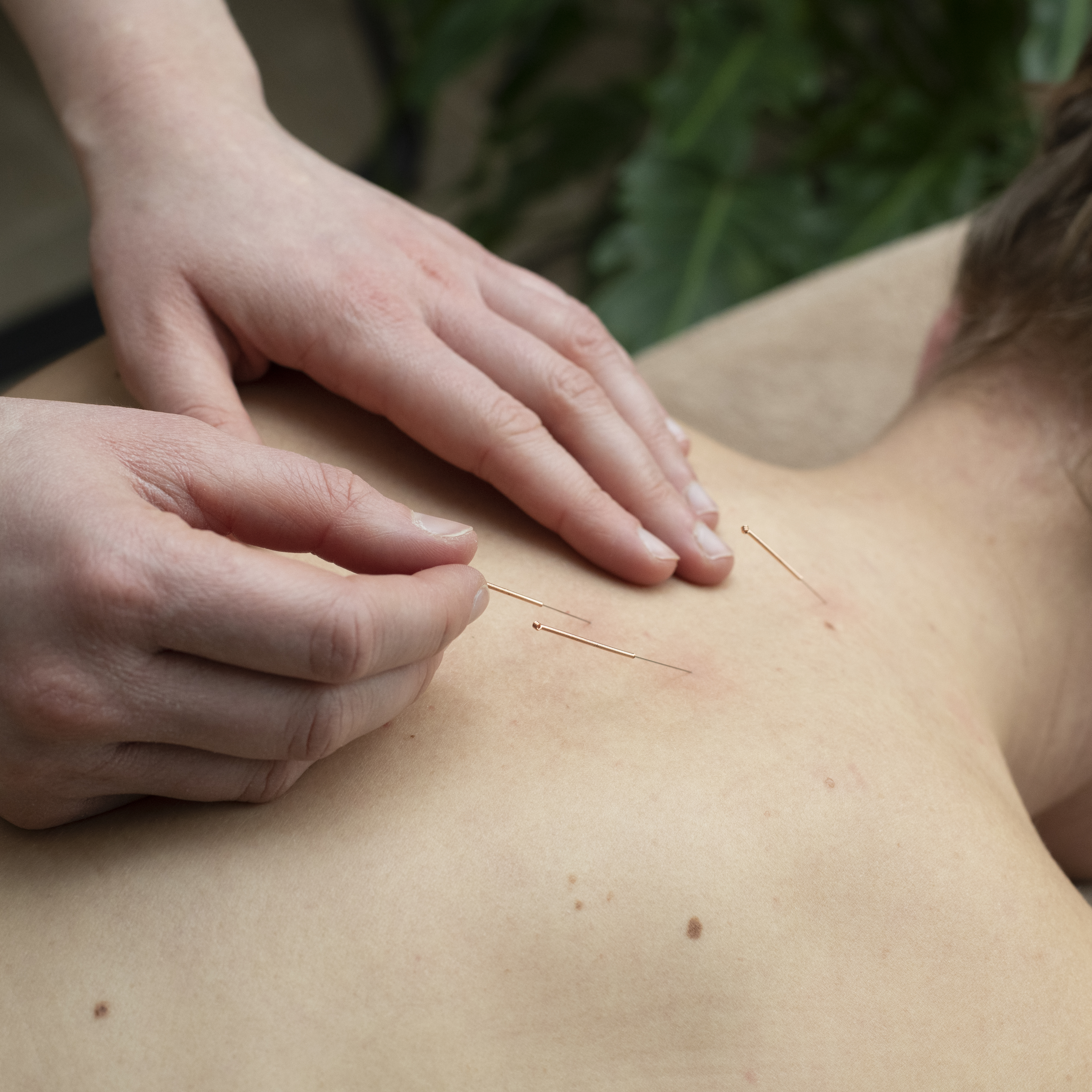 Wat is dry needling en hoe kan het jou helpen?